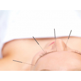 acupuntura orelha clinica Setor Leste Gama (Gama)