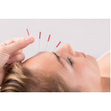 acupuntura para dor de cabeça Gama
