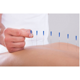 acupuntura para enxaqueca clinica Ceilândia Norte Ceilândia (Ceilândia)